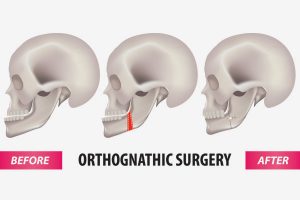 Orthognathic-Surgery