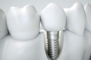 Dental-Implant