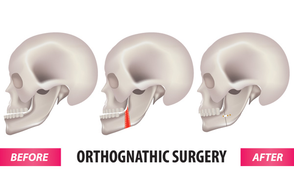 Orthognathic-Surgery