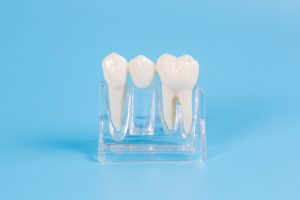 A model of a dental bridge that can be used as an alternative to dental implants or permanent dentures