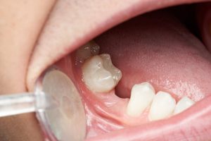 Photo of a space in the mouth where a dental implant should be placed using a dental implant procedure
